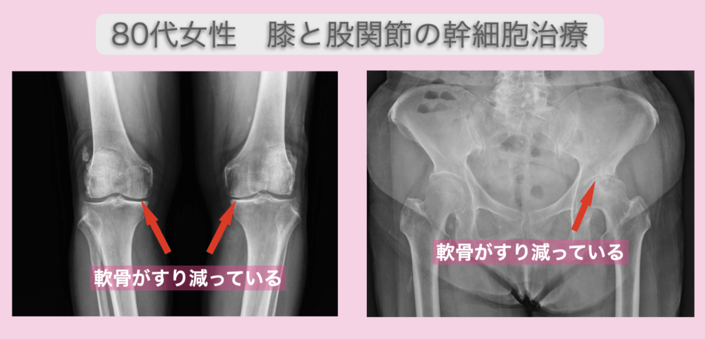 膝と股関節の幹細胞治療