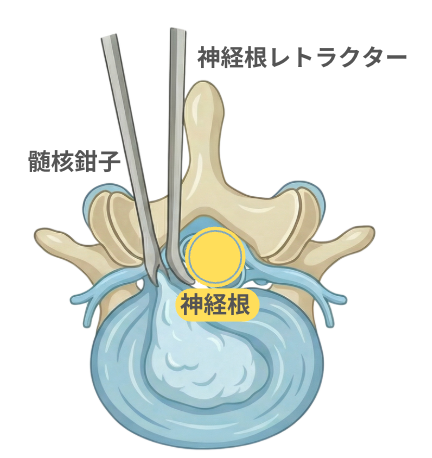 器具操作で神経を傷つけるリスク
