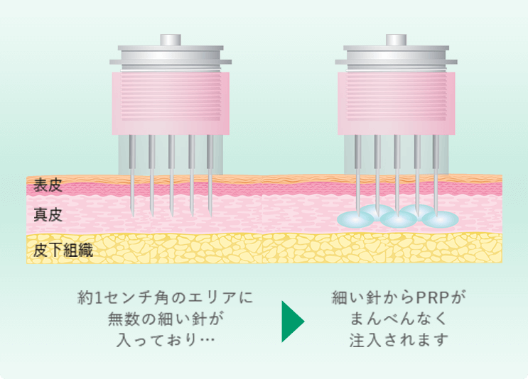 約1センチ角のエリアに無数の細い針が入っており…細い針からPRPがまんべんなく注入されます