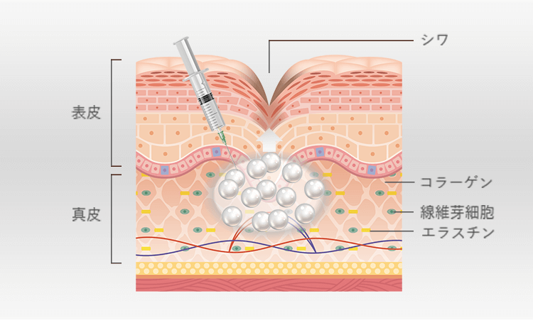 ヒアルロン酸の注入