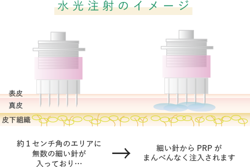 水光注射のイメージ