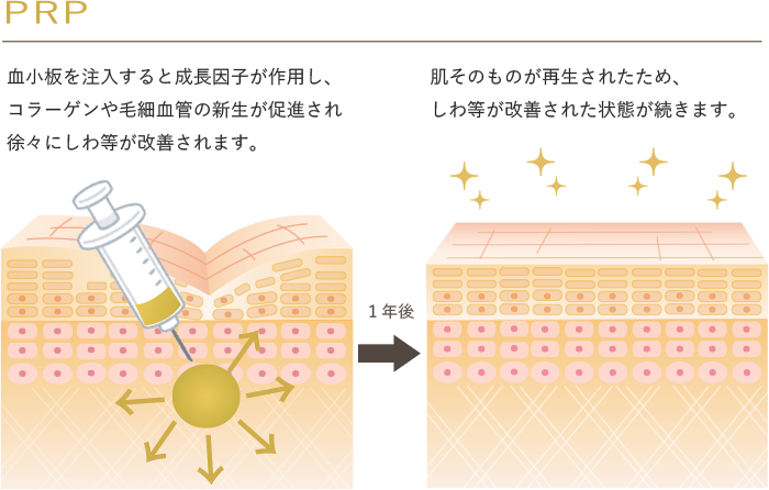 PRP
