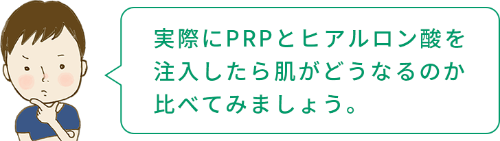 実際にPRPとヒアルロン酸を注入したら肌がどうなるか比べる