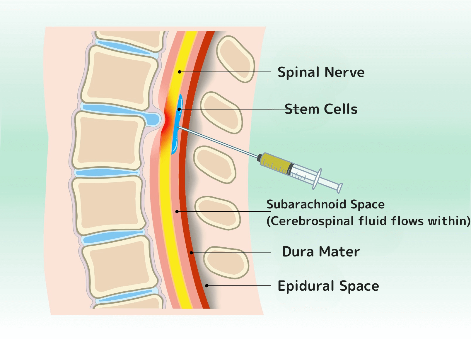 脊髄内への直接投与する幹細胞療法