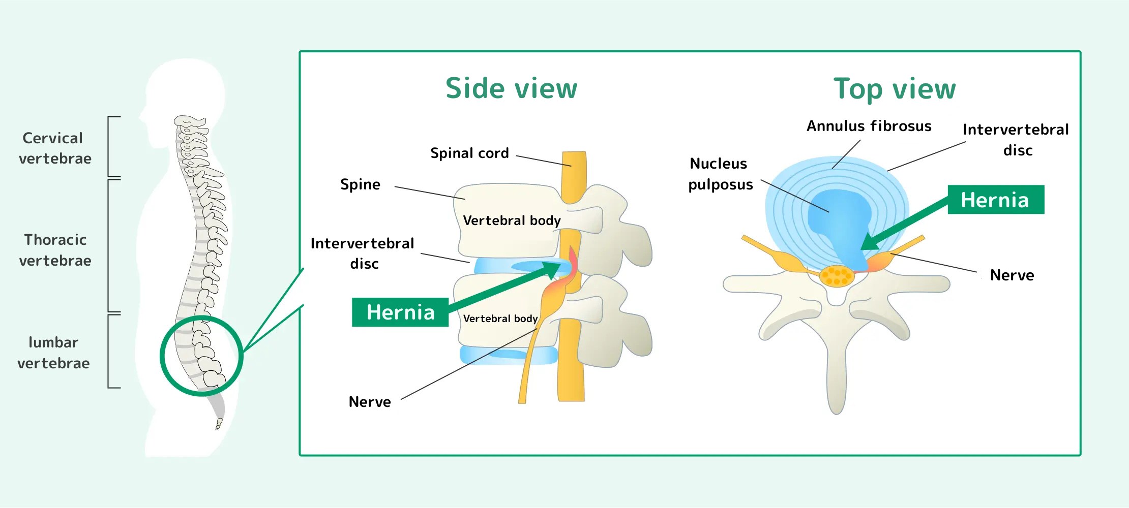 椎間板ヘルニアとは