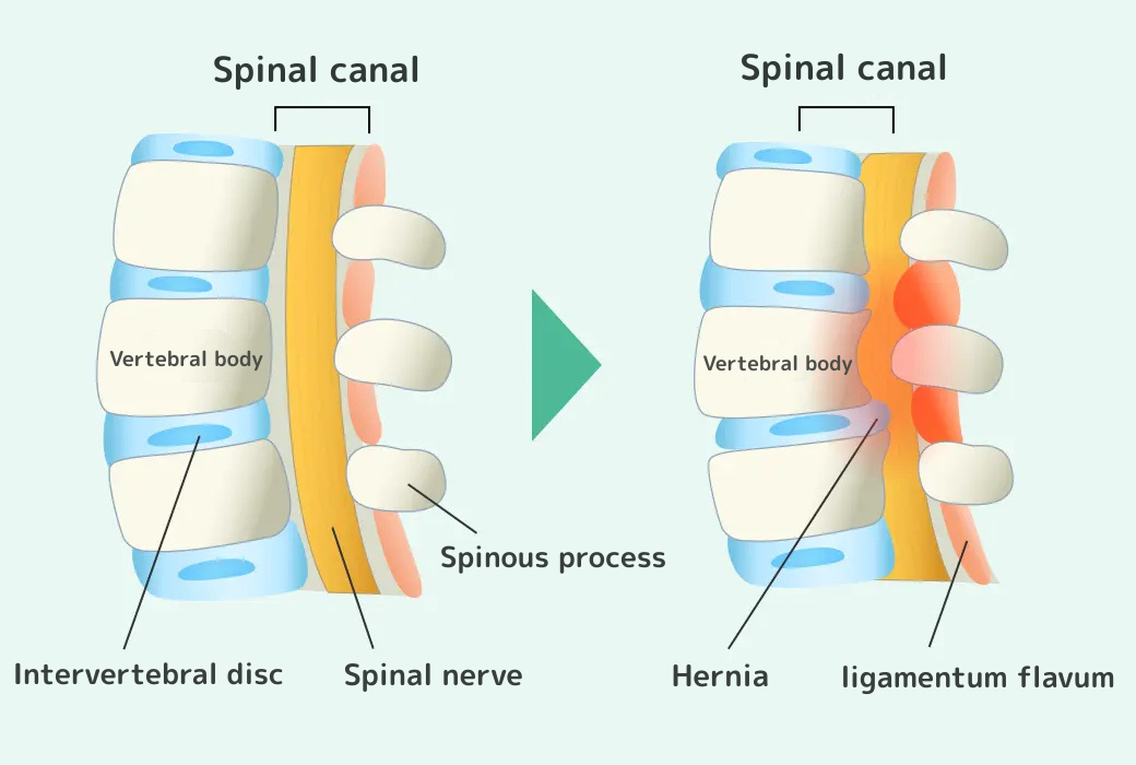 頚椎椎間板ヘルニア・腰椎椎間板ヘルニア