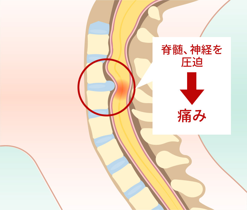 頚椎ヘルニア