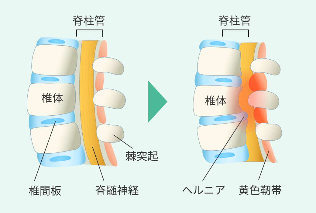 頚椎椎間板ヘルニア・腰椎椎間板ヘルニア