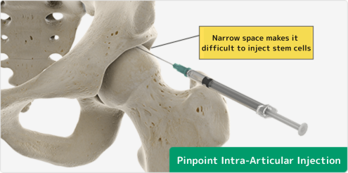 股関節への関節内ピンポイント注射は当院独自