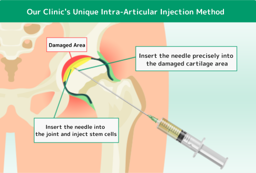当院独自の股関節内への投与方法