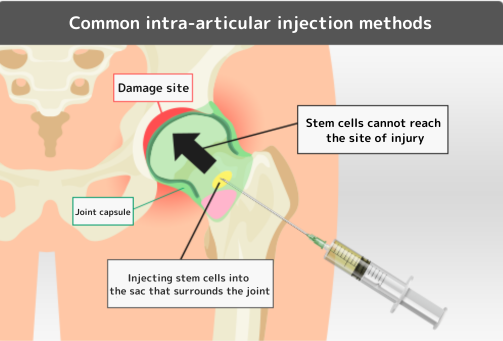 一般的な股関節内投与方法