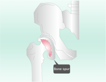 股関節の骨が変形する