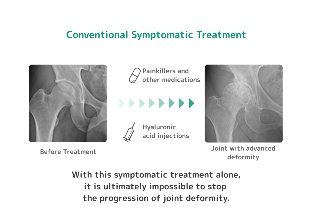 従来の対症療法では、股関節が変形する進行は止められない