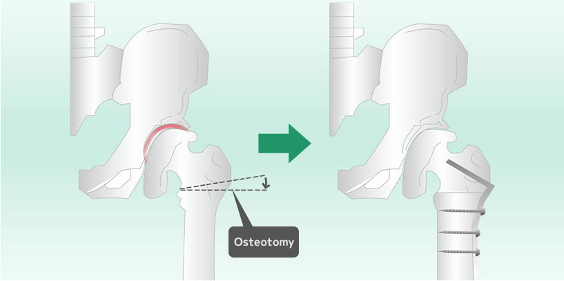 股関節の治療、外反骨切り術