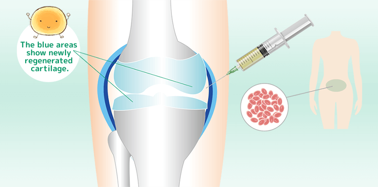 変形性膝関節症の幹細胞治療