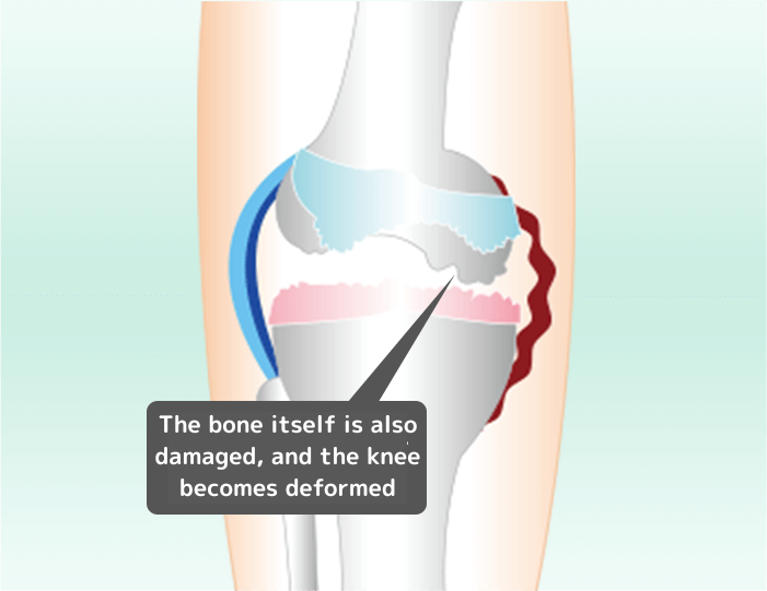 変形性膝関節症、ひざが変形