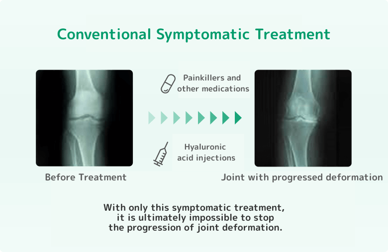 変形性膝関節症の進行は対症療法（痛止薬やヒアルロン酸注射）では止まらない