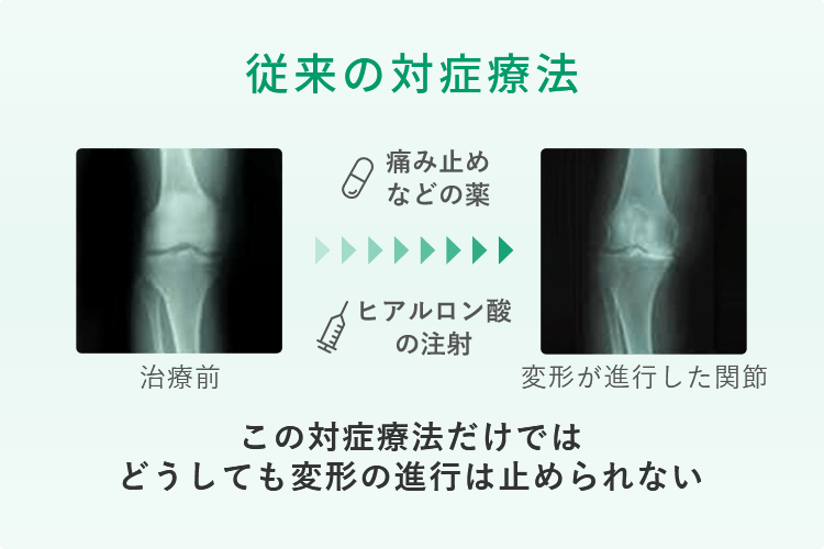 膝の痛み、変形性膝関節症の再生医療・幹細胞治療