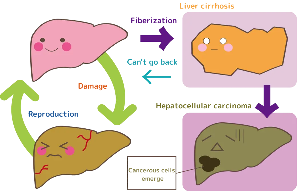 肝硬変→肝細胞ガン(ガン化する細胞が出てくる)