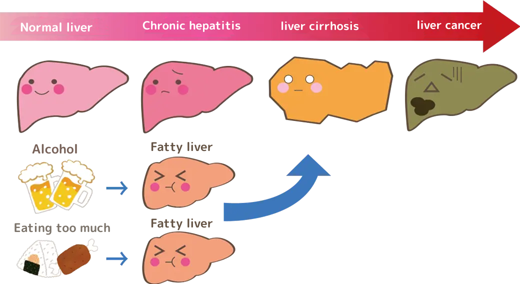 正常な肝臓→慢性肝炎→肝硬変→肝ガン