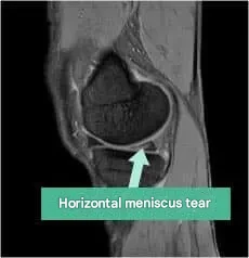 半月板が水平に断裂