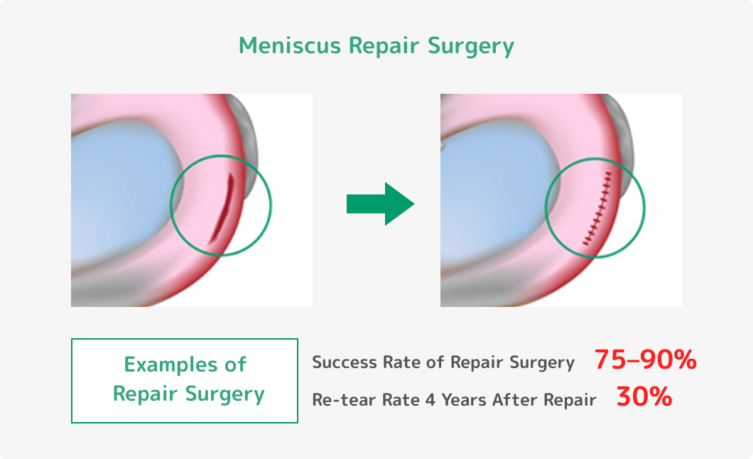 【半月板縫合術】縫合術の成功率75～90%、縫合術して4年後の再断裂30%