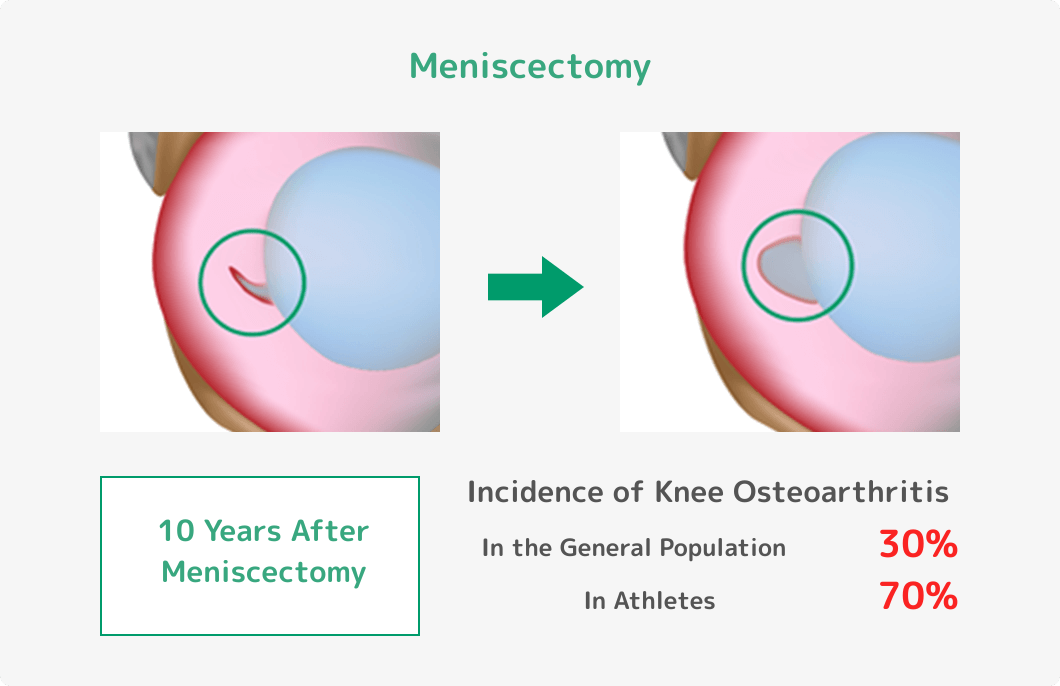【半月板切除術】切除術十年後の変形性ひざ関節症の発症率：一般の方の場合30%、スポーツ選手の場合70%