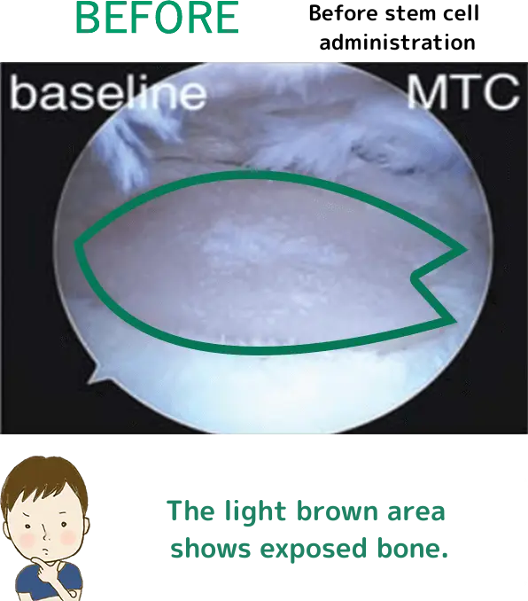 BEFORE(幹細胞投与前)坂本くん「薄い茶色の部分は骨がむき出しになっているね」