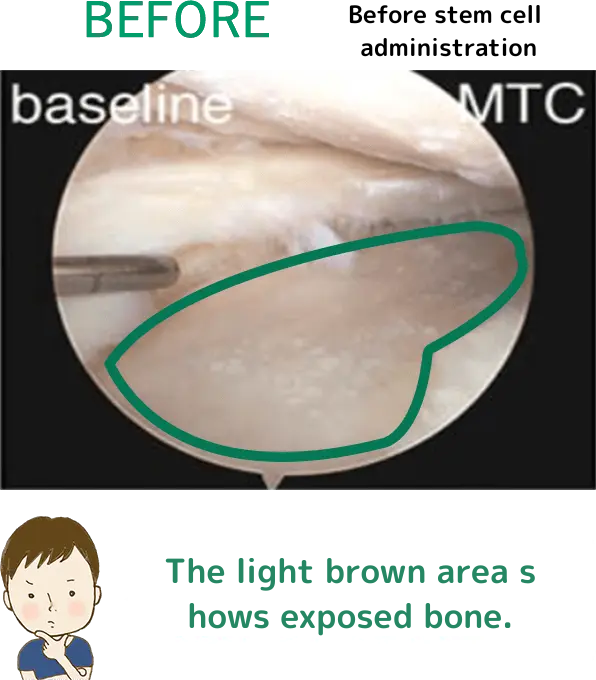 BEFORE(幹細胞投与前)坂本くん「薄い茶色の部分は骨がむき出しになっているね」