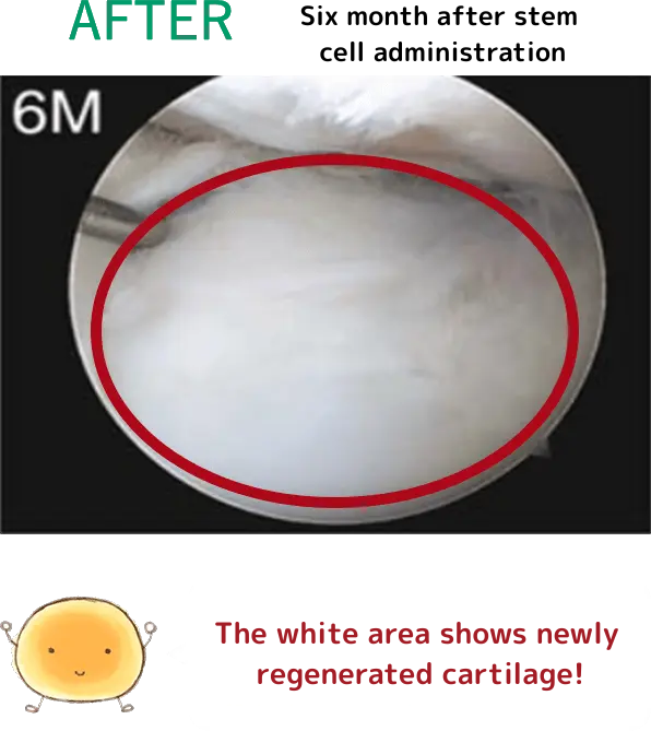 AFTER(幹細胞投与6ヶ月目)細胞くん「白い部分が新しく軟骨が再生されたんだ!」