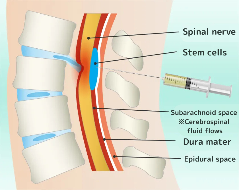 脊髄腔内ダイレクト注射療法