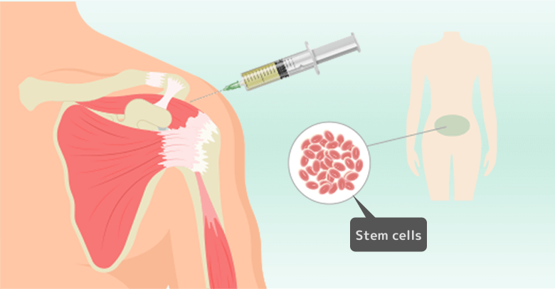 肩の腱板損傷に対する幹細胞治療