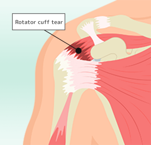 腱板断裂している状態