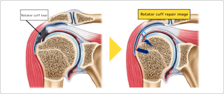 腱板断裂から腱板を修復