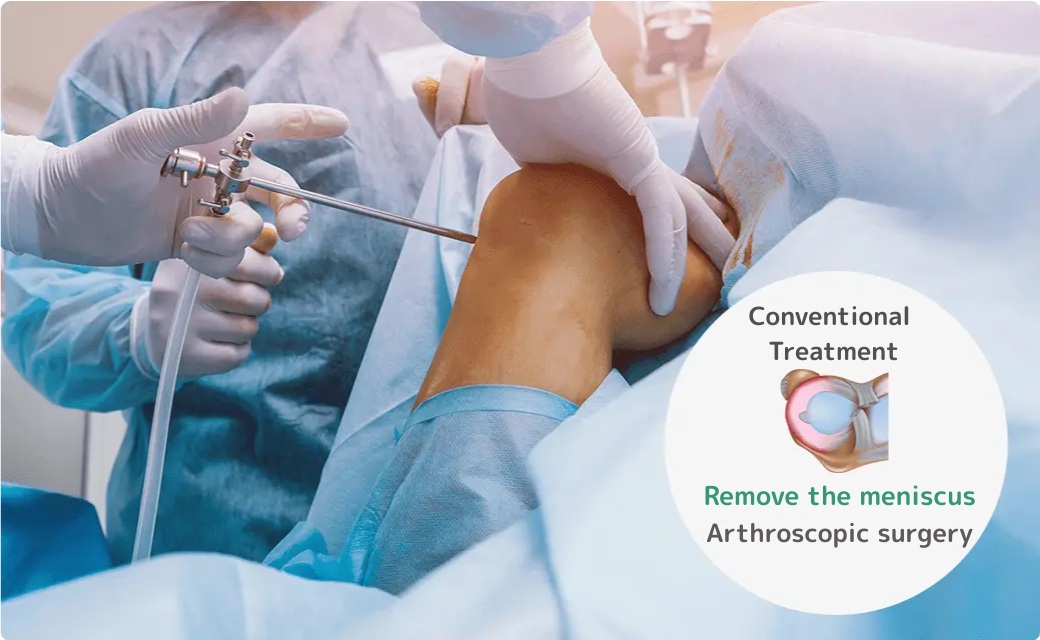 従来の治療だと半月板を取り除く関節鏡手術が必要