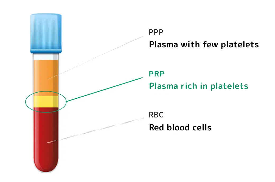 PRP（多血小板血漿）療法とは
