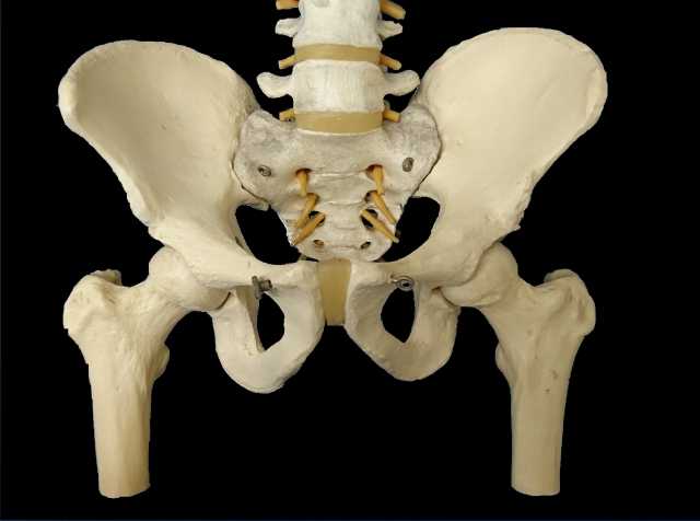 変形性股関節症の骨盤