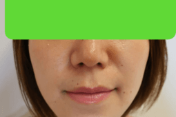 顔のPRP療法