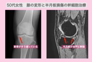 変形性膝関節症　半月板損傷の幹細胞治療