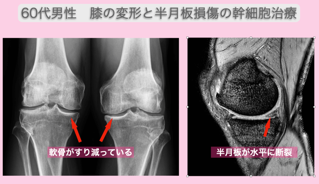 半月板損傷と変形性膝関節症の幹細胞治療