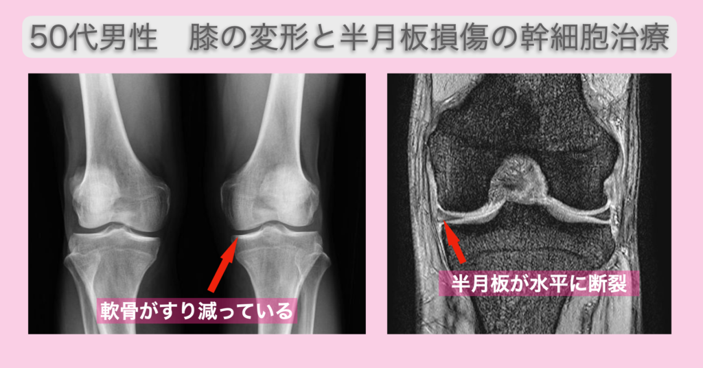 半月板損傷と変形性膝関節症の再生医療
