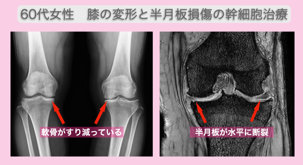 変形性膝関節症の再生医療
