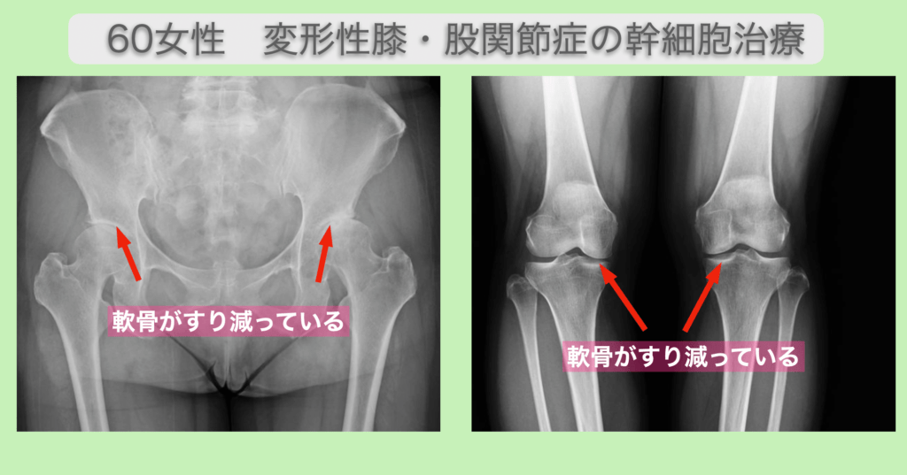 変形性膝・股関節症の幹細胞投与
