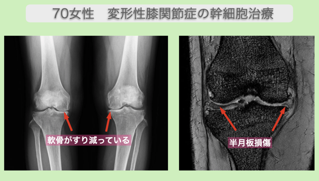 変形性膝関節症の幹細胞治療