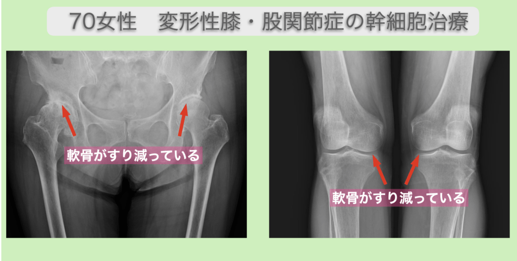 変形性股関節で右が痛い場合の幹細胞治療