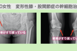 変形性膝関節症と変形性股関節症に対する幹細胞治療
