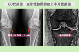 変形性膝関節症と半月板損傷の幹細胞治療