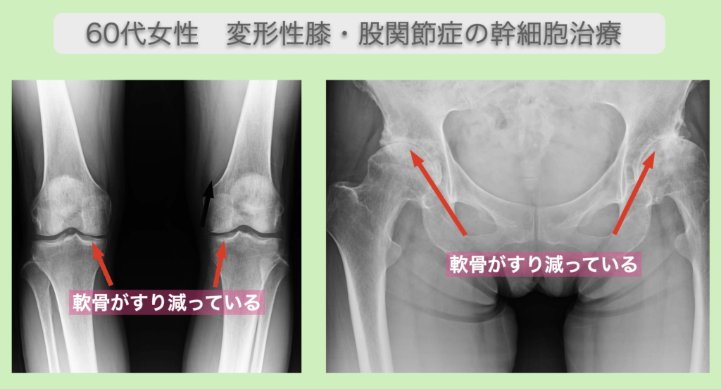 膝と股関節の再生医療