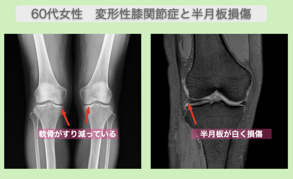 変形性膝関節症と半月板損傷の再生医療