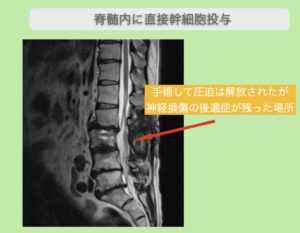腰部脊柱管狭窄症術後の幹細胞投与